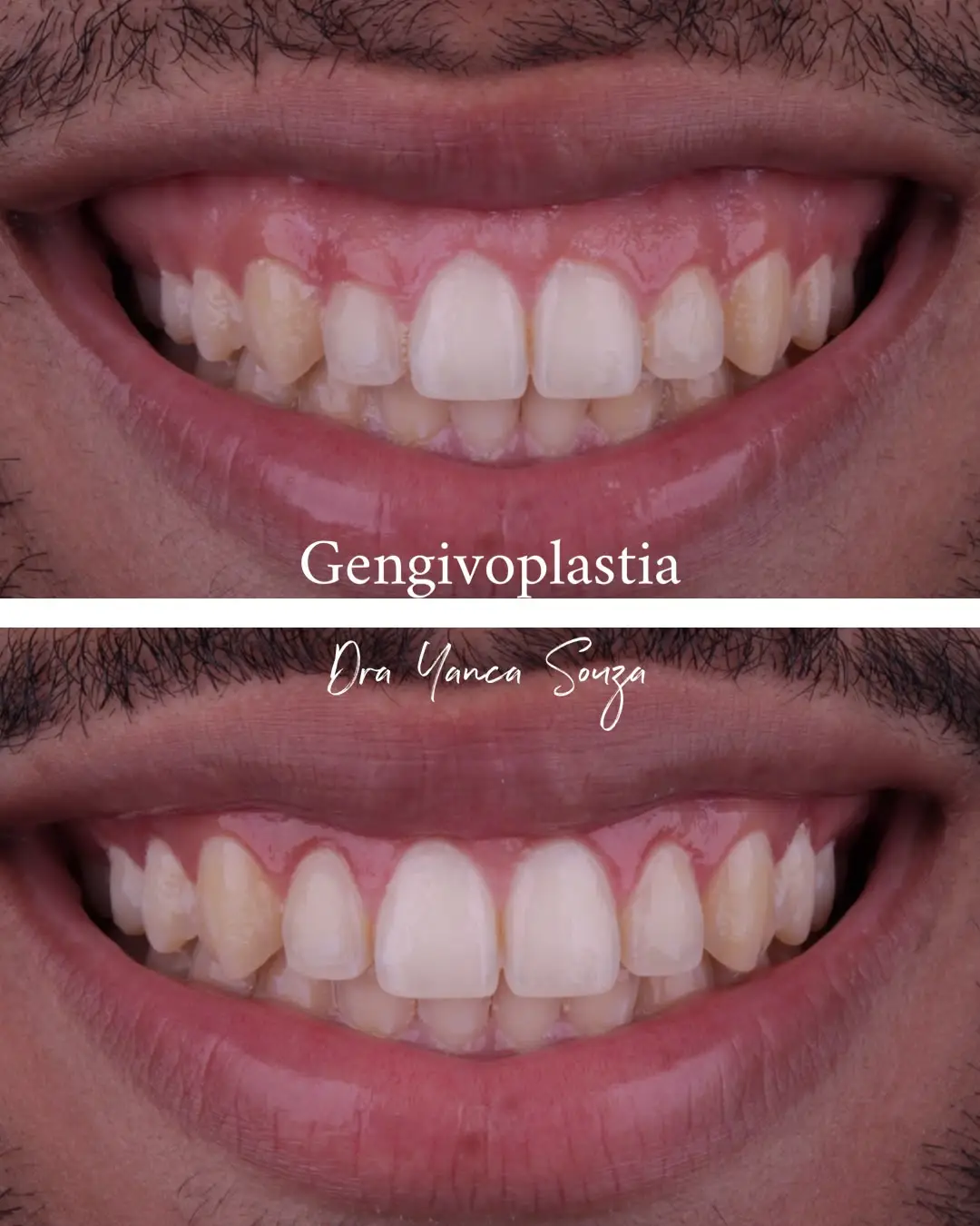 Antes e depois de cirurgia de gengivoplastia em Santo André