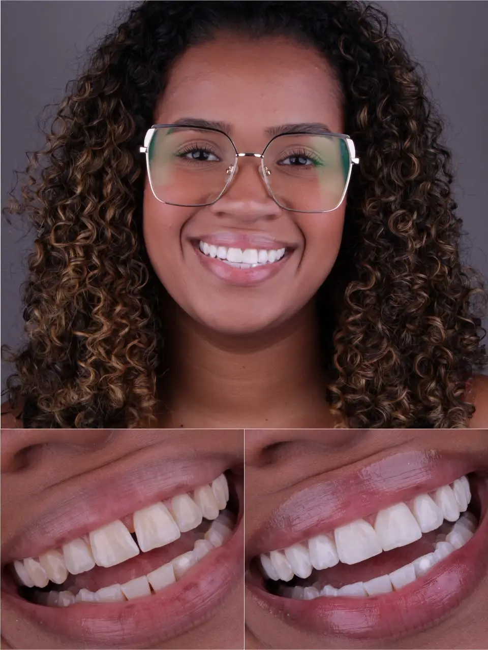 Antes e depois do clareamento dental em Santo André